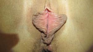Labia Minoraplasty