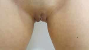 Labia Minoraplasty