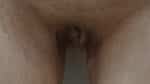 Labia Minoraplasty