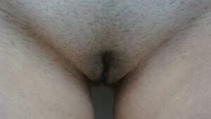 Labia Minoraplasty