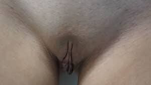 Labia Minoraplasty