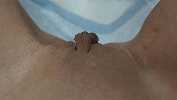 Labia Minoraplasty