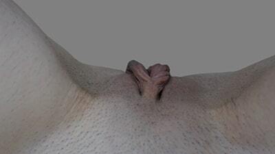 Labia Minoraplasty