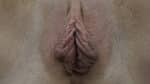 Labia Minoraplasty