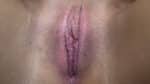 Labia Minoraplasty
