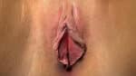 Labia Minoraplasty