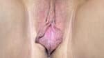 Labia Minoraplasty