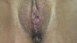 Labia Minoraplasty