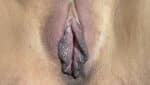 Labia Minoraplasty