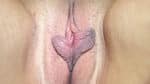 Labia Minoraplasty