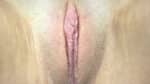 Labia Minoraplasty
