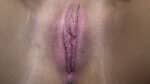 Labia Minoraplasty