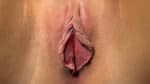 Labia Minoraplasty