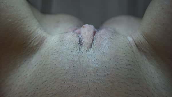 Labia Minoraplasty