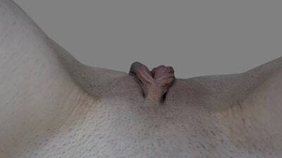 Labia Minoraplasty
