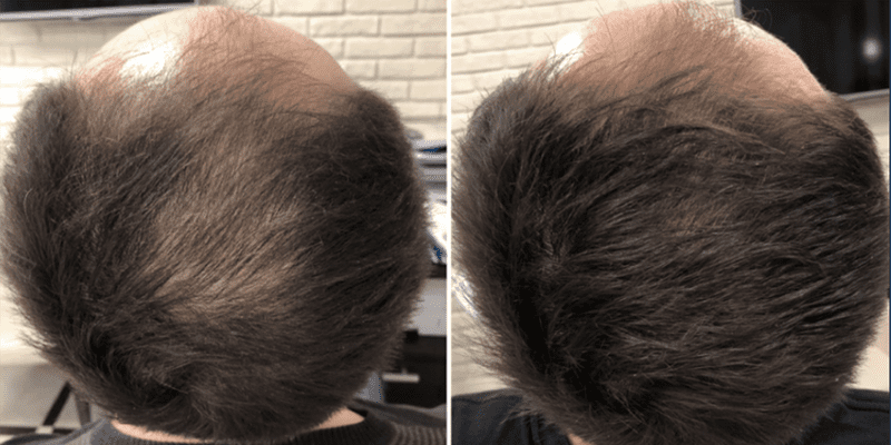 Exosome Hair Restoration before and after