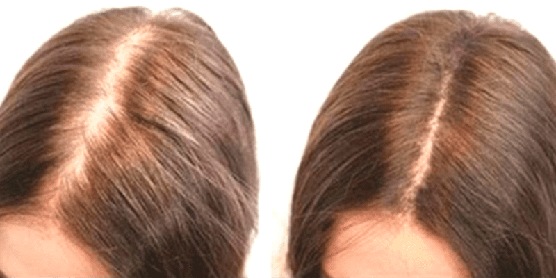 Exosome Hair Restoration before and after