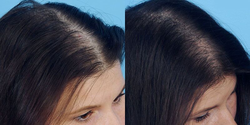 Exosome Hair Restoration before and after